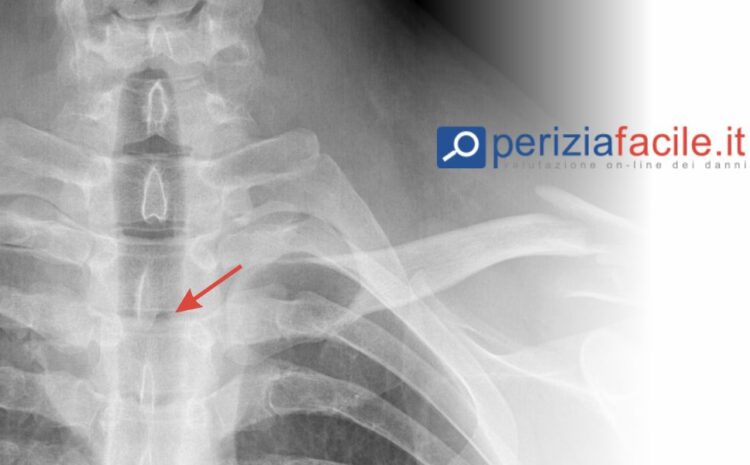 Quanto viene valutato un infortunio con frattura vertebre?