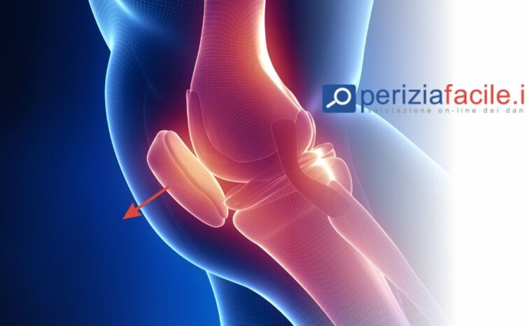  Quanto ammonta l’invalidità operazione al menisco 